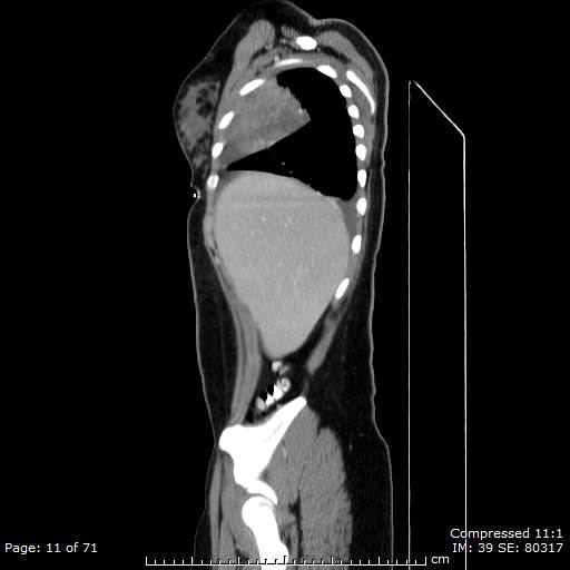 File:Anterior mediastinal B cell Lymphoma (Radiopaedia 50677-56114 C 6).jpg