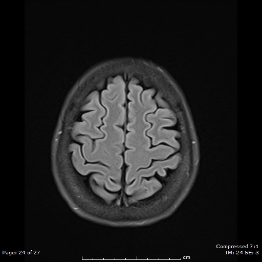 File:Anterior temporal lobe perivascular space (Radiopaedia 88283-104914 Axial FLAIR 24).jpg