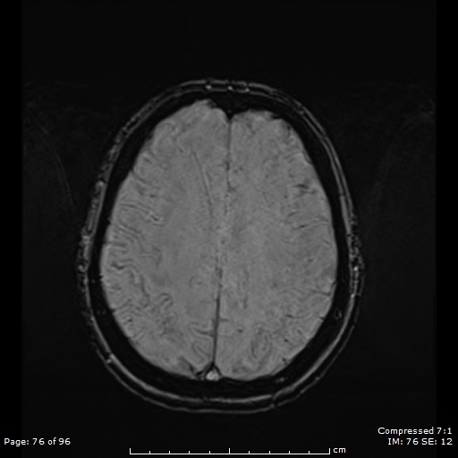 Anterior temporal lobe perivascular space (Radiopaedia 88283-104914 Axial SWI 45).jpg