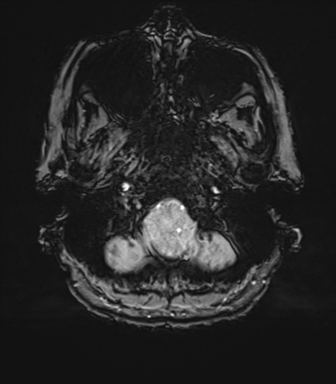 Anterior temporal pole cysts (Radiopaedia 46629-51102 Axial SWI 12).png