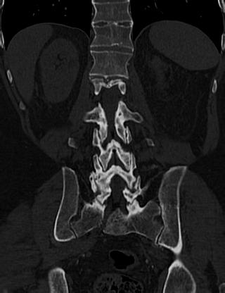 File:Anterior vertebral scalloping (abdominal aortic aneurysm) (Radiopaedia 66744-76067 Coronal bone window 50).jpg