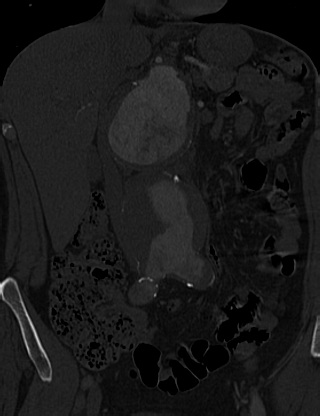 File:Anterior vertebral scalloping (abdominal aortic aneurysm) (Radiopaedia 66744-76067 Coronal bone window 9).jpg