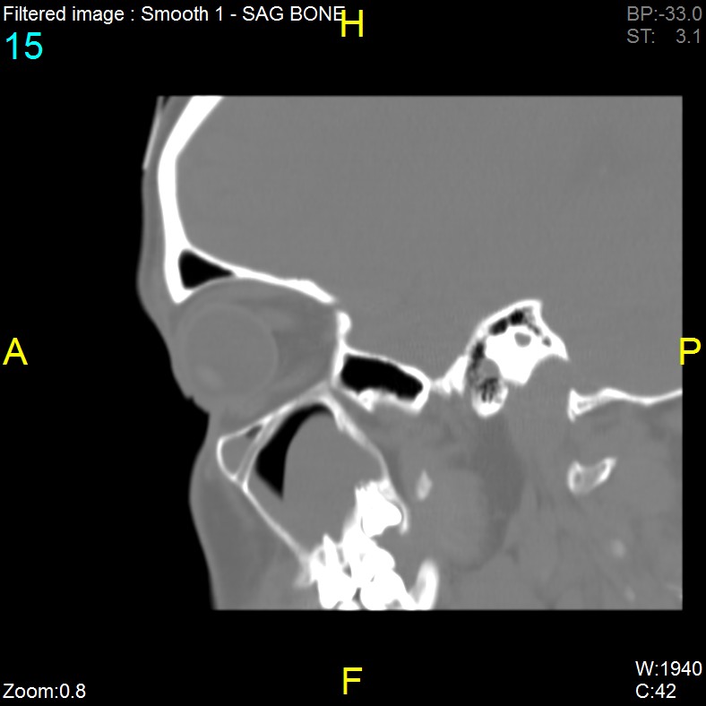 Antrochoanal polyp (Radiopaedia 65101-74094 Sagittal bone window 15).jpg