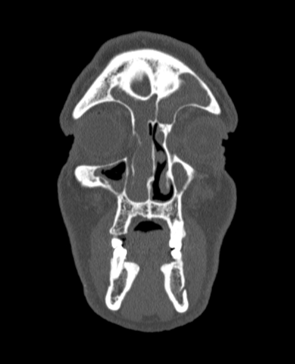 Antrochoanal polyp (Radiopaedia 79011-92169 Coronal bone window 70).jpg