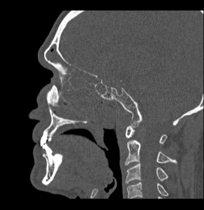 Antrochoanal polyp (Radiopaedia 79011-92169 Sagittal bone window 19).jpg