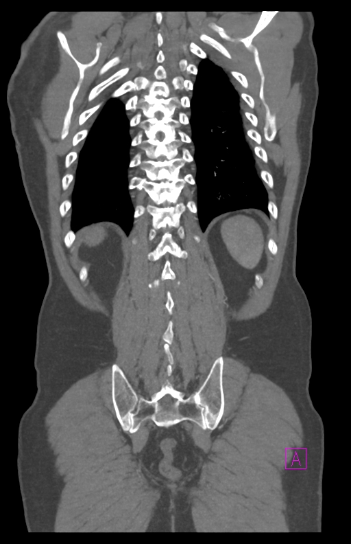 Aortectomy and axillary-bifemoral bypass (Radiopaedia 28303-28545 C 76).jpg
