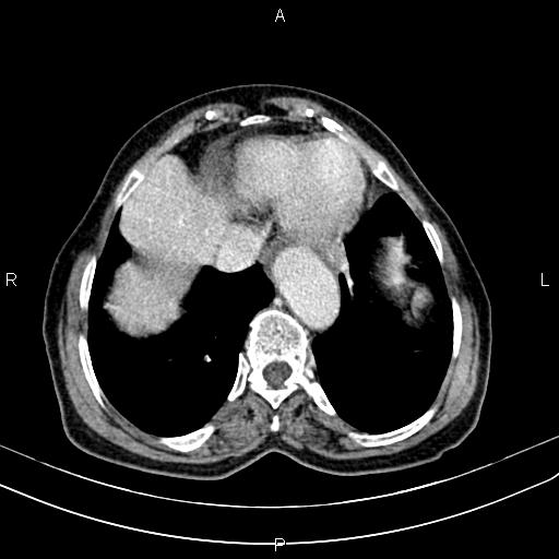 File:Aortic aneurysm and Lemmel syndrome (Radiopaedia 86499-102554 A 11).jpg
