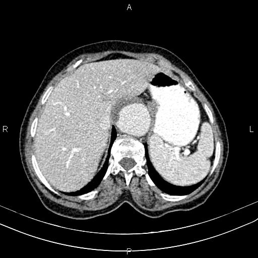 Aortic aneurysm and Lemmel syndrome (Radiopaedia 86499-102554 A 18).jpg