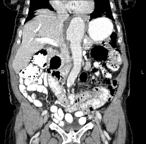 Aortic aneurysm and Lemmel syndrome (Radiopaedia 86499-102554 C 24).jpg