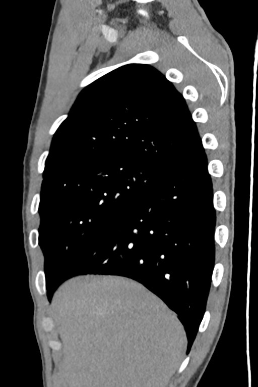 Aortic coarctation with aneurysm (Radiopaedia 74818-85828 B 36).jpg