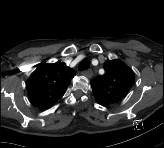 File:Aortic dissection (CTPA) (Radiopaedia 75506-86750 A 17).jpg