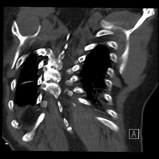 File:Aortic dissection (CTPA) (Radiopaedia 75506-86750 B 66).jpg