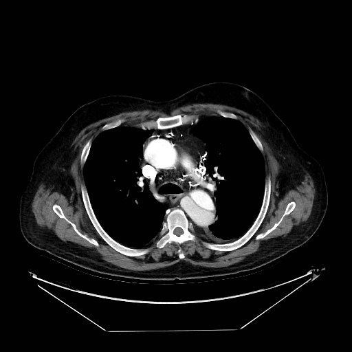 Aortic dissection (Radiopaedia 62562-71000 A 12).jpg
