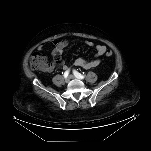 Aortic dissection (Radiopaedia 62562-71000 A 86).jpg