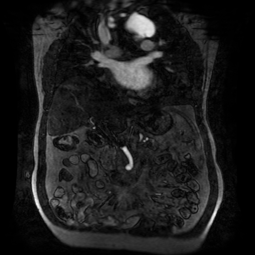 File:Aortic dissection - Stanford A - DeBakey I (Radiopaedia 23469-23551 D 103).jpg