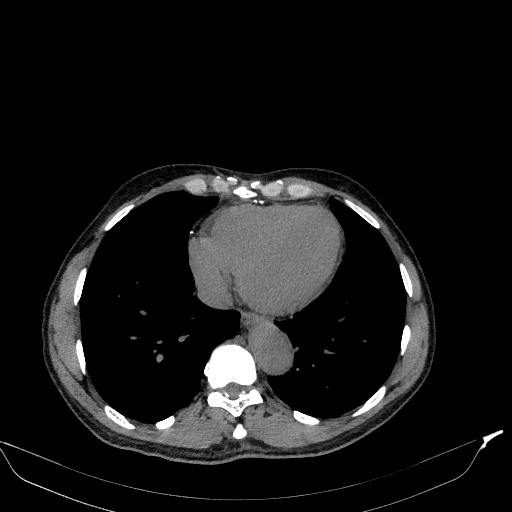 Aortic dissection - Stanford type A (Radiopaedia 83418-98500 Axial non-contrast 32).jpg