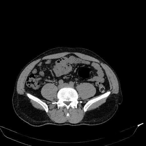 File:Aortic dissection - Stanford type A (Radiopaedia 83418-98500 Axial non-contrast 68).jpg