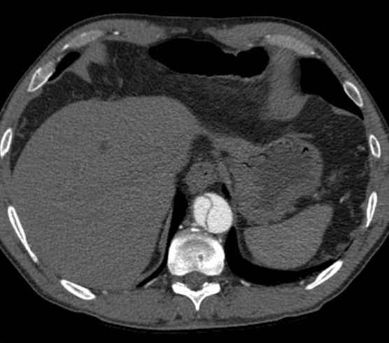 Aortic dissection - Stanford type B (Radiopaedia 73648-84437 A 100).jpg