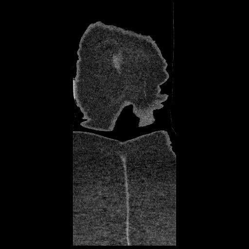 Aortic dissection - Stanford type B (Radiopaedia 88281-104910 B 97).jpg