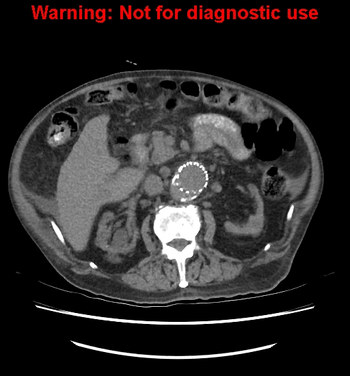 Aortic graft infection (Radiopaedia 44979-48907 Axial non-contrast 43).jpg