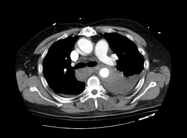 File:Aortic intramural hematoma (Radiopaedia 11198-11562 Axial 2).jpg