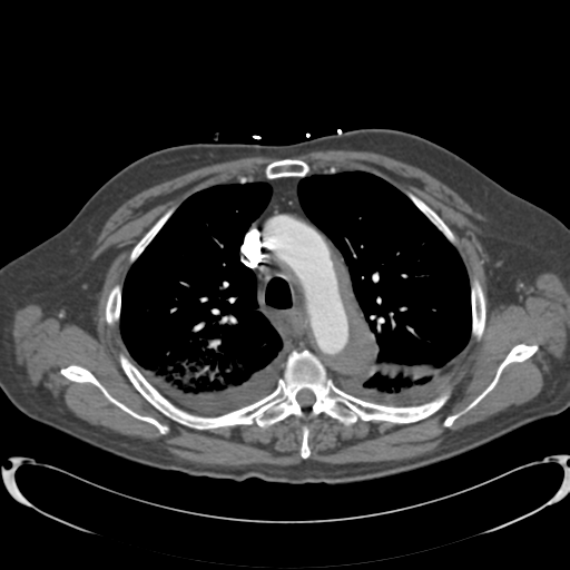 Aortic intramural hematoma (Radiopaedia 34260-35540 B 11).png
