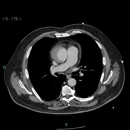 Aortic intramural hematoma (Radiopaedia 48463-53380 C 79).jpg