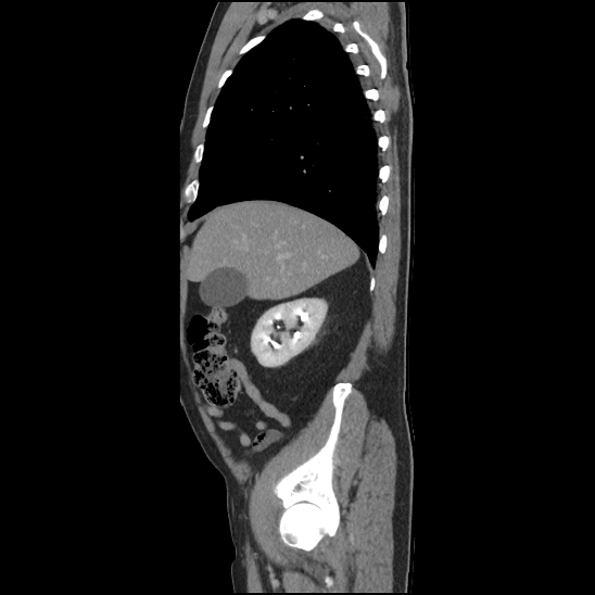 Aortic intramural hematoma (type B) (Radiopaedia 79323-92387 Sagittal C+ delayed 7).jpg