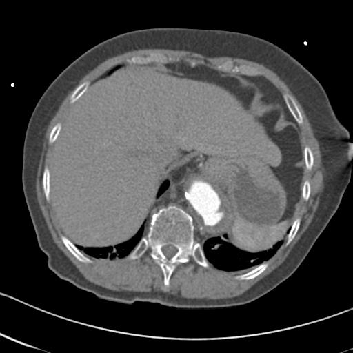 File:Aortic intramural hematoma from penetrating atherosclerotic ulcer (Radiopaedia 31137-31836 A 68).jpg