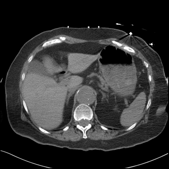 Aortic intramural hematoma with dissection and intramural blood pool (Radiopaedia 77373-89491 Axial non-contrast 97).jpg