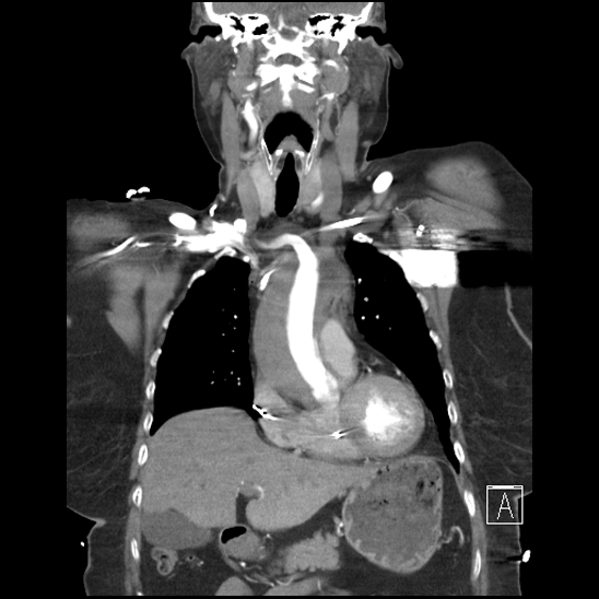 File:Aortic intramural hematoma with dissection and intramural blood pool (Radiopaedia 77373-89491 C 19).jpg