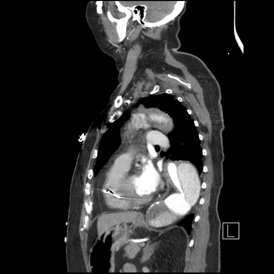 File:Aortic intramural hematoma with dissection and intramural blood pool (Radiopaedia 77373-89491 D 56).jpg
