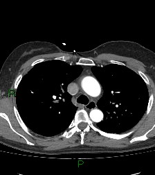 File:Aortic valve endocarditis (Radiopaedia 87209-103485 C 31).jpg