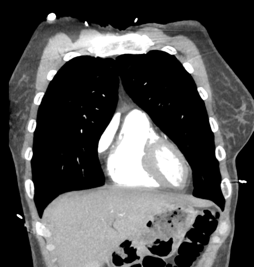 File:Aortic valve non-coronary cusp thrombus (Radiopaedia 55661-62189 C 21).png