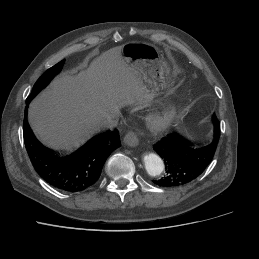 File:Aorto-coronary bypass graft aneurysms (Radiopaedia 40562-43157 A 101).png
