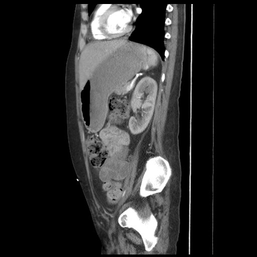 File:Aorto-duodenal fistula (Radiopaedia 25668-25850 C+ arterial phase 16).jpg