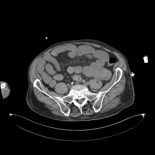 Aortoduodenal fistula (Radiopaedia 75286-86415 Axial non-contrast 50).jpg
