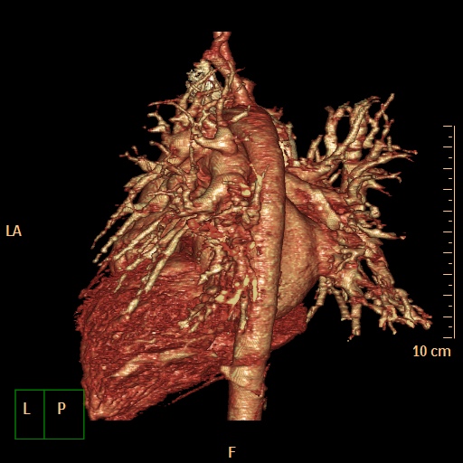 File:Aortopulmonary septal defect (Radiopaedia 41990-45013 3D reconstruction 9).jpg