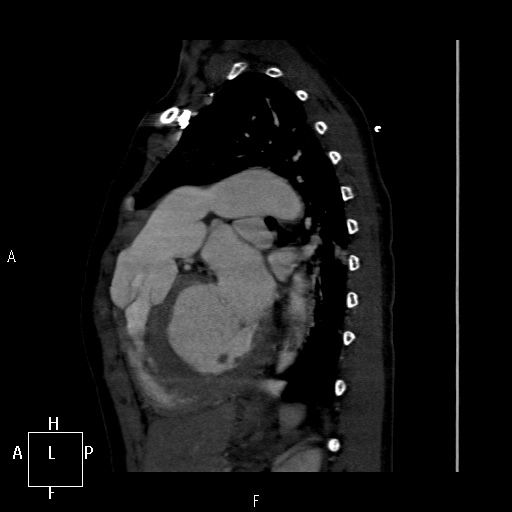 File:Aortopulmonary septal defect (Radiopaedia 41990-45013 Sagittal C+ CTPA 15).jpg