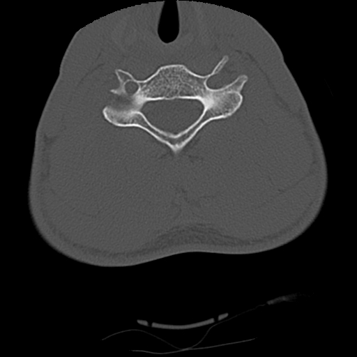 Apical pneumothorax on cervical spine CT (Radiopaedia 45343-49368 Axial bone window 60).jpg