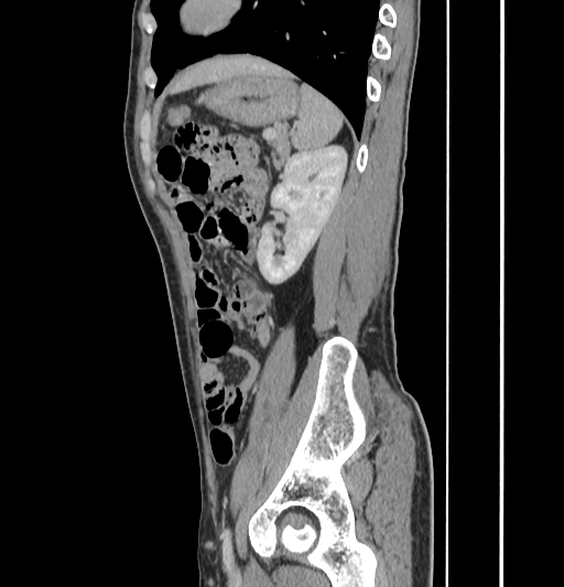 Appendiceal mucinous adenocarcinoma (Radiopaedia 66605-75922 C 51).jpg