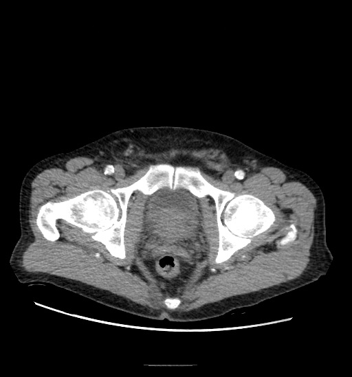 Appendicitis with localized perforation and abscess formation (Radiopaedia 49035-54130 A 83).jpg