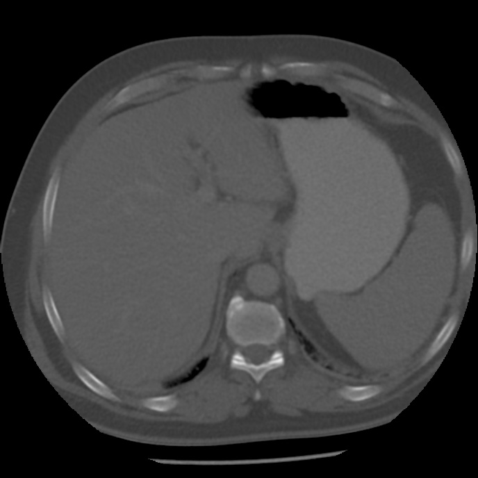 Appendicitis with perforation (Radiopaedia 35790-37342 Axial bone window 9).jpg