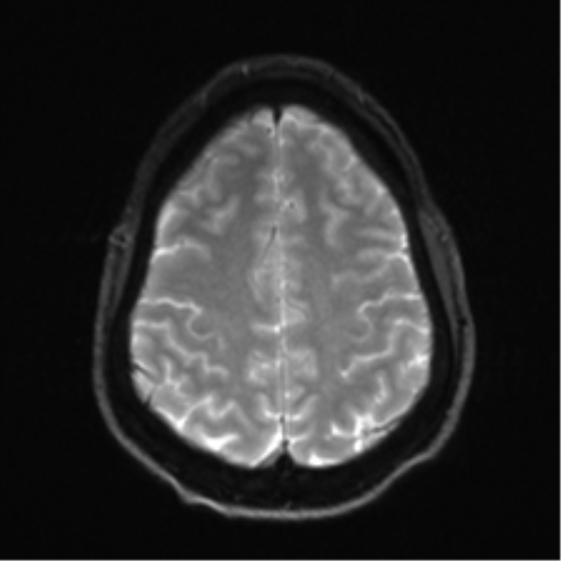 File:Arachnoid cyst - cerebellopontine angle (Radiopaedia 59689-67083 Axial DWI 28).png