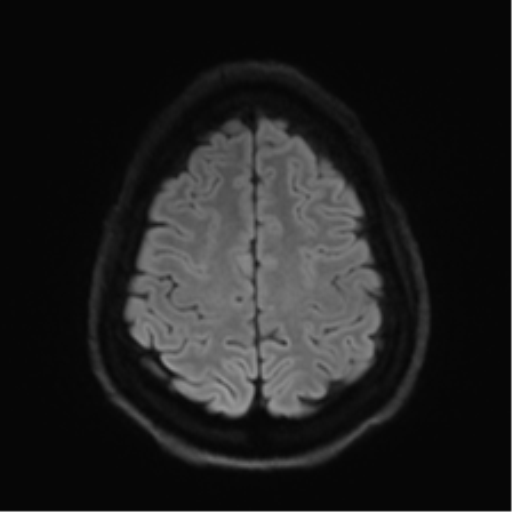 Arachnoid cyst - cerebellopontine angle (Radiopaedia 59689-67083 Axial DWI 65).png