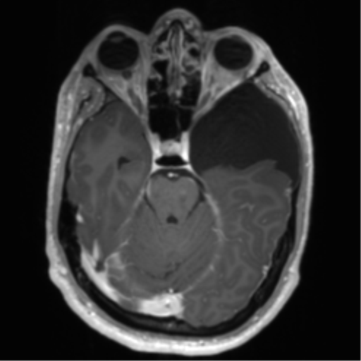Arachnoid cyst with subdural hematoma (Radiopaedia 85892-101743 Axial T1 C+ 32).png
