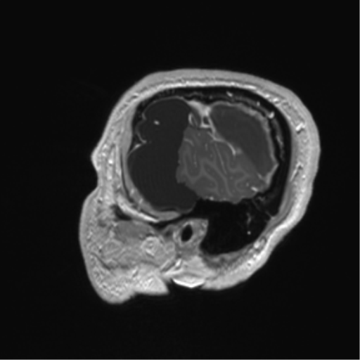 Arachnoid cyst with subdural hematoma (Radiopaedia 85892-101743 Sagittal T1 C+ 14).png