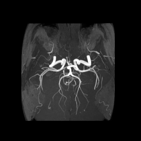 Artery of Percheron infarct (Radiopaedia 40966-43676 F 42).jpg