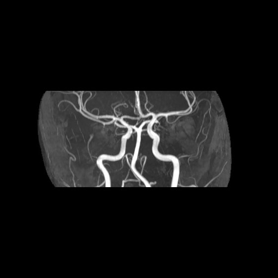 File:Artery of Percheron infarct (Radiopaedia 40966-43676 G 29).jpg