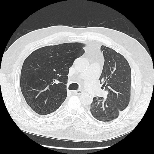 Asbestos-related pleural disease (Radiopaedia 74366-85250 Axial lung window 48).jpg